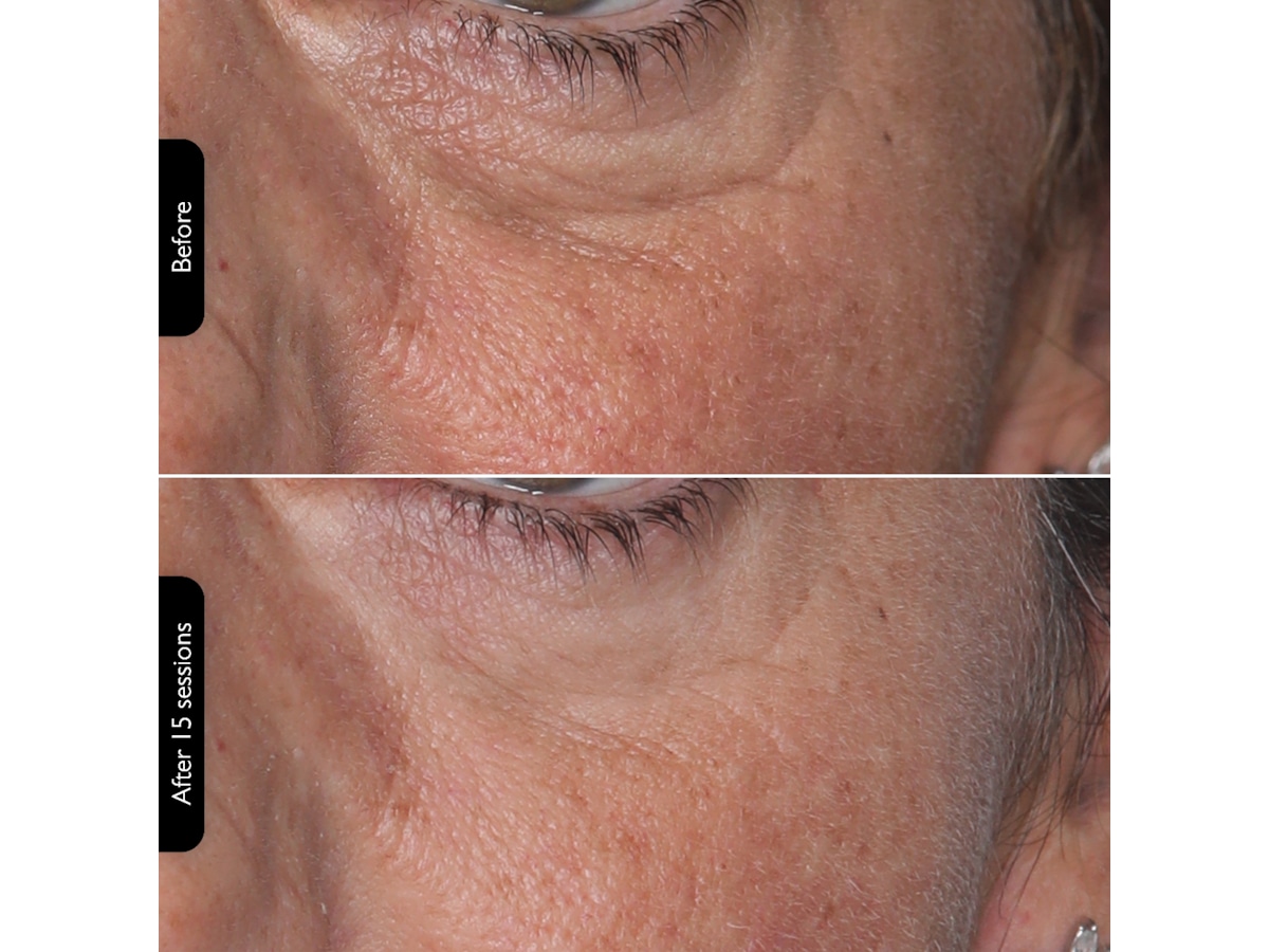 Silk'n Facial LED Mask Ansigtspleje