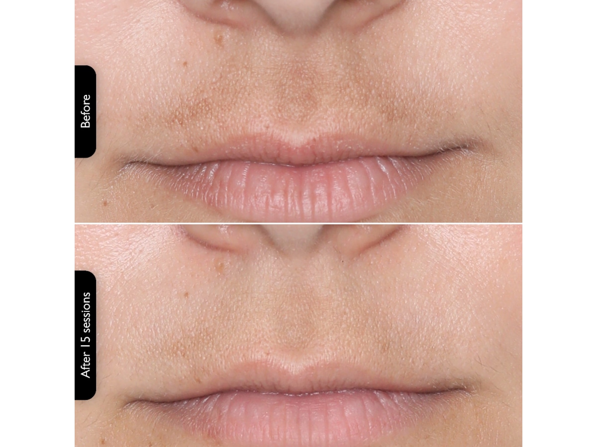 Silk'n Facial LED Mask Ansigtspleje