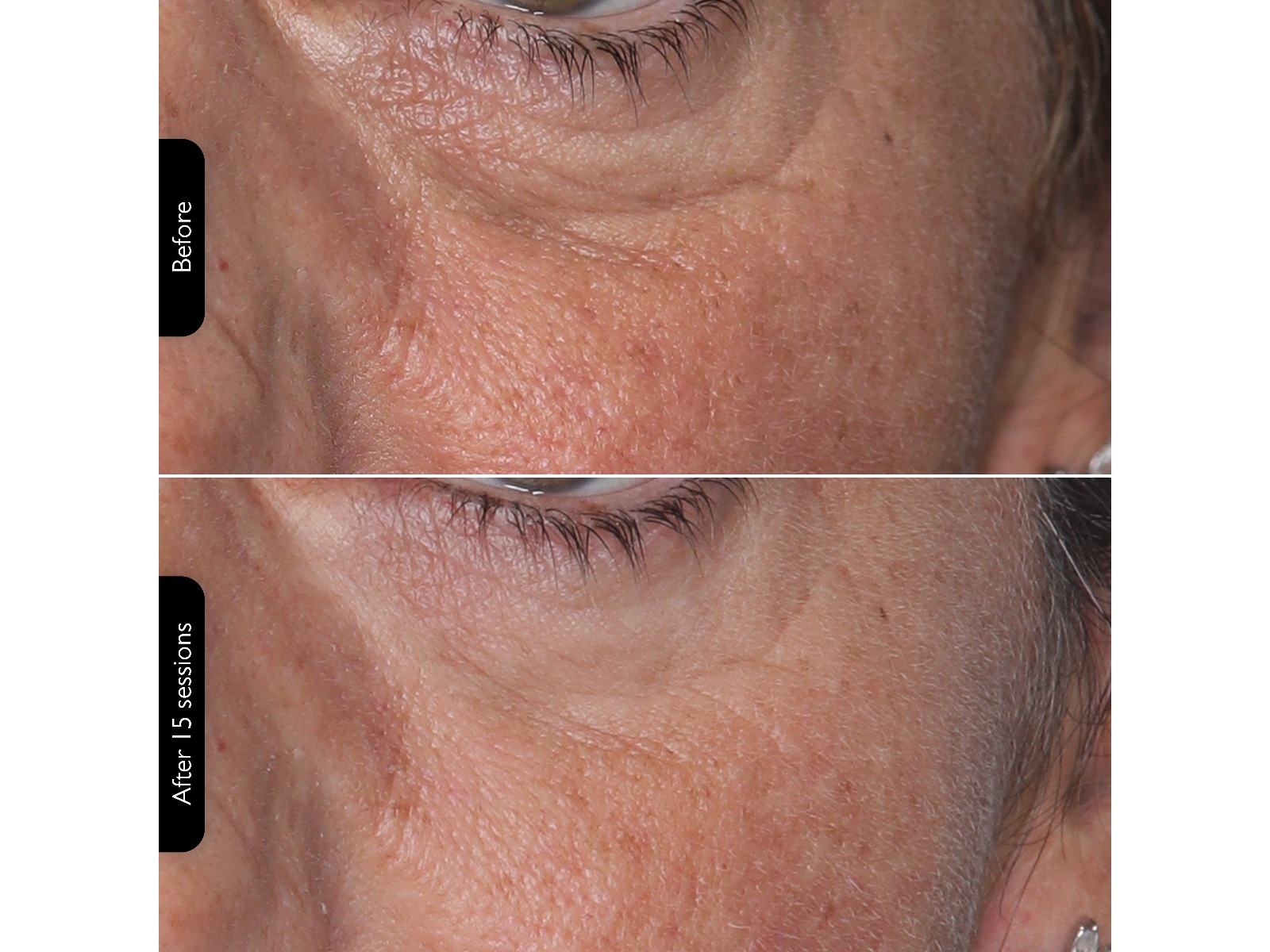 Silk'n Facial LED Mask Ansigtspleje