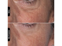 Silk'n Facial LED Mask Ansigtspleje