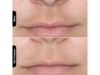 Silk'n Facial LED Mask Ansigtspleje