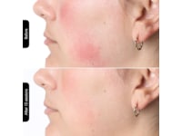 Silk'n Facial LED Mask Ansigtspleje