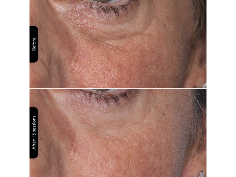 Silk'n Facial LED Mask Ansigtspleje