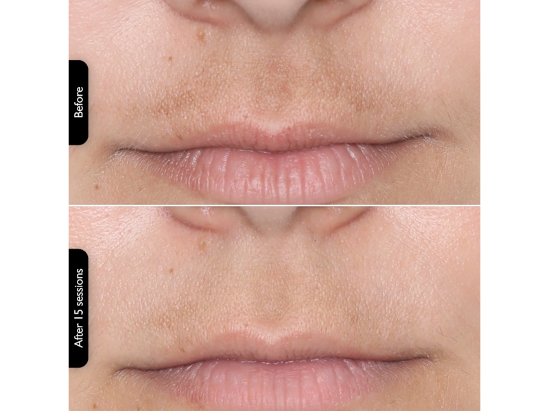 Silk'n Facial LED Mask Ansigtspleje